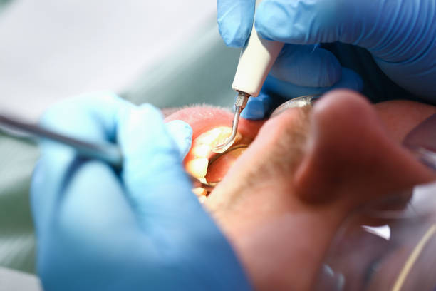 Best Emergency Treatment for Dental Infections or Abscesses in Carrollton, MO
